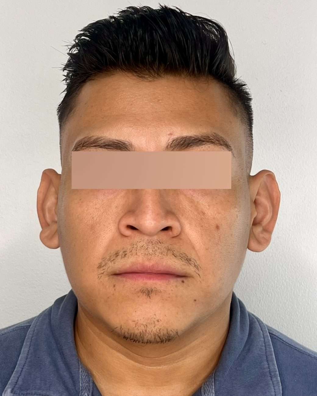 otoplastia