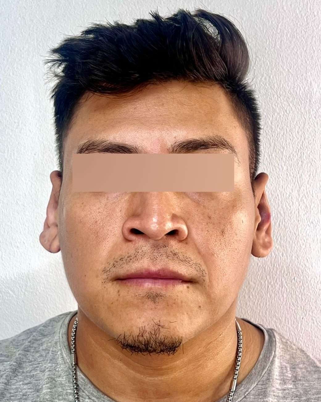 otoplastia el salvador