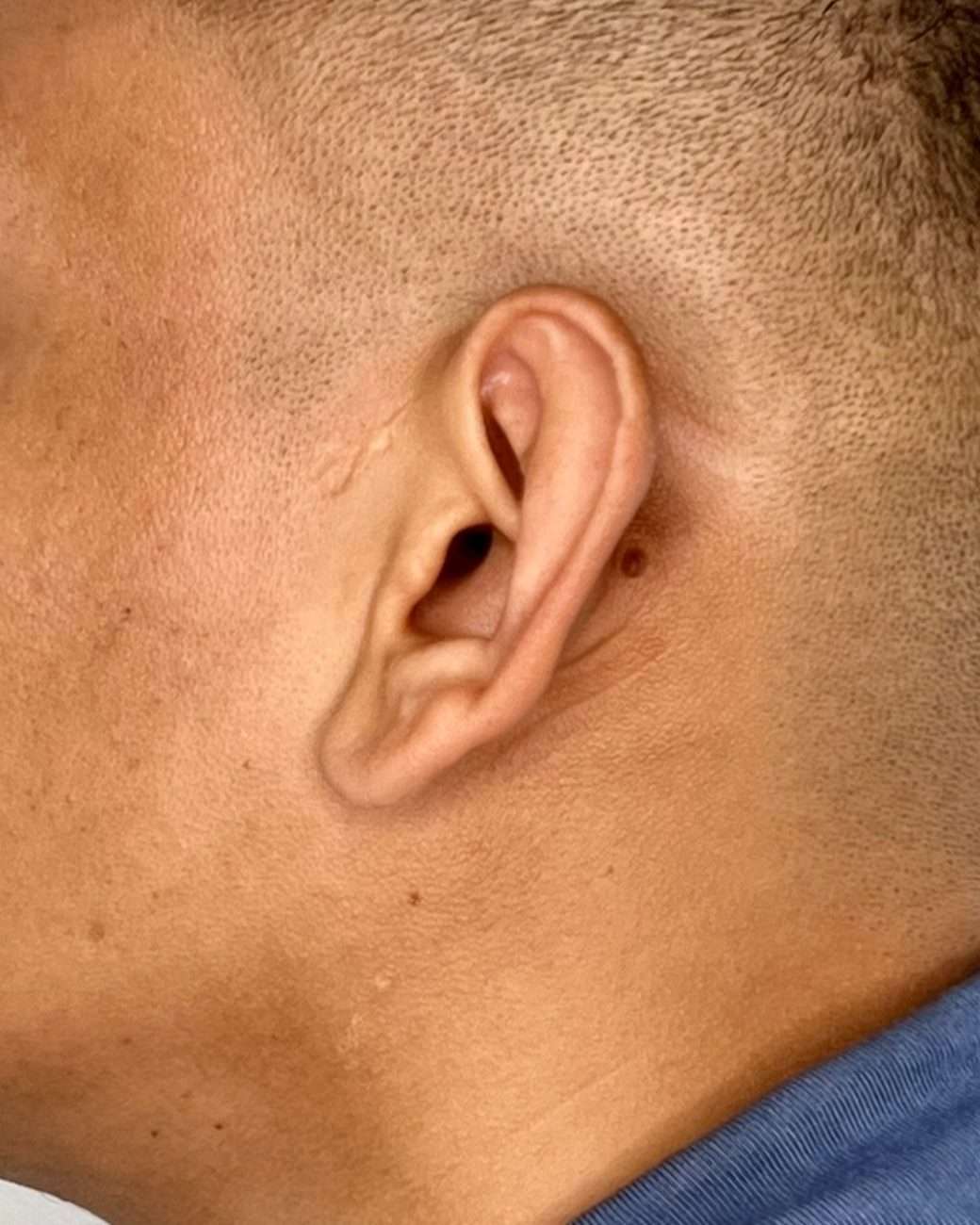 otoplastia
