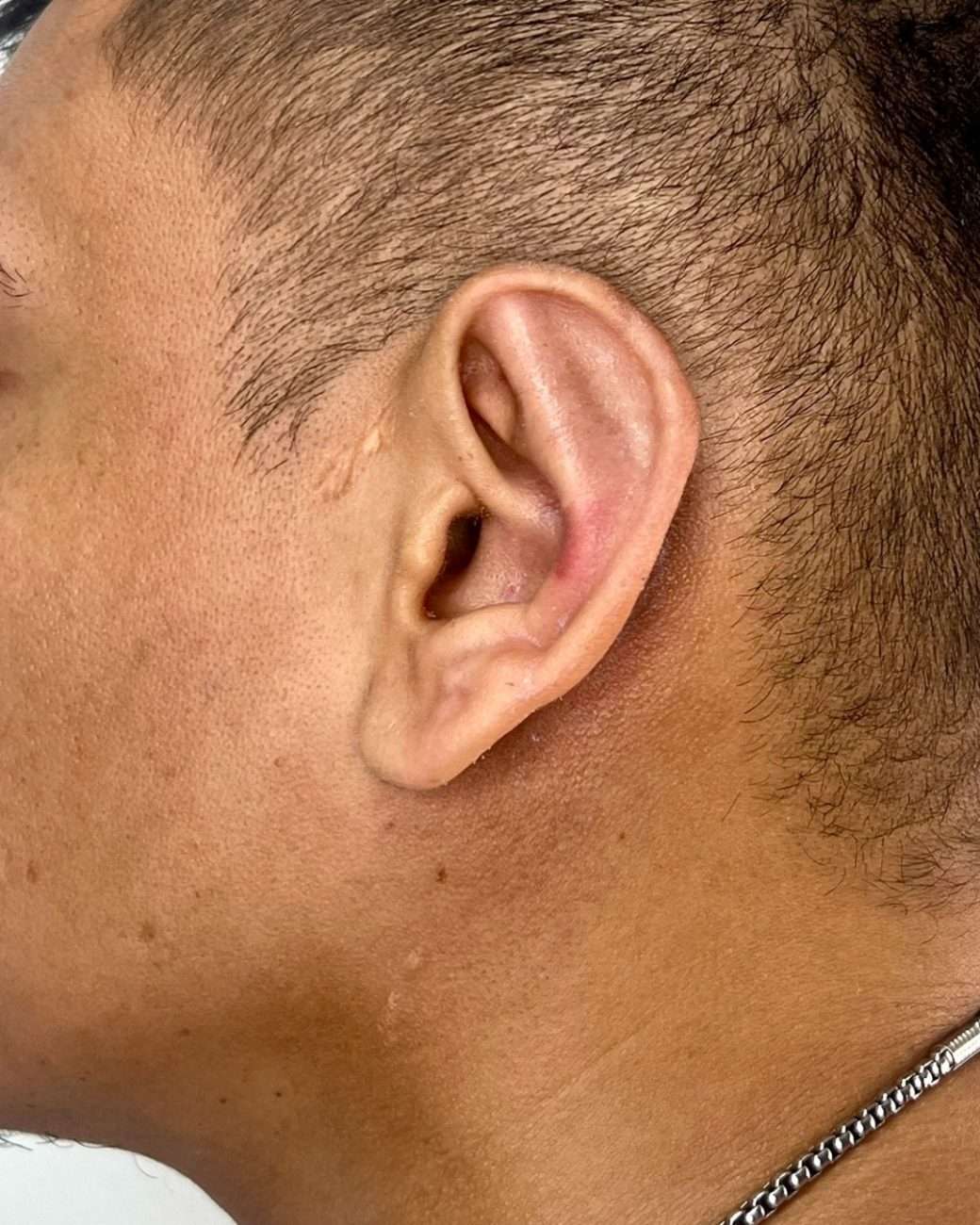 otoplastia el salvador
