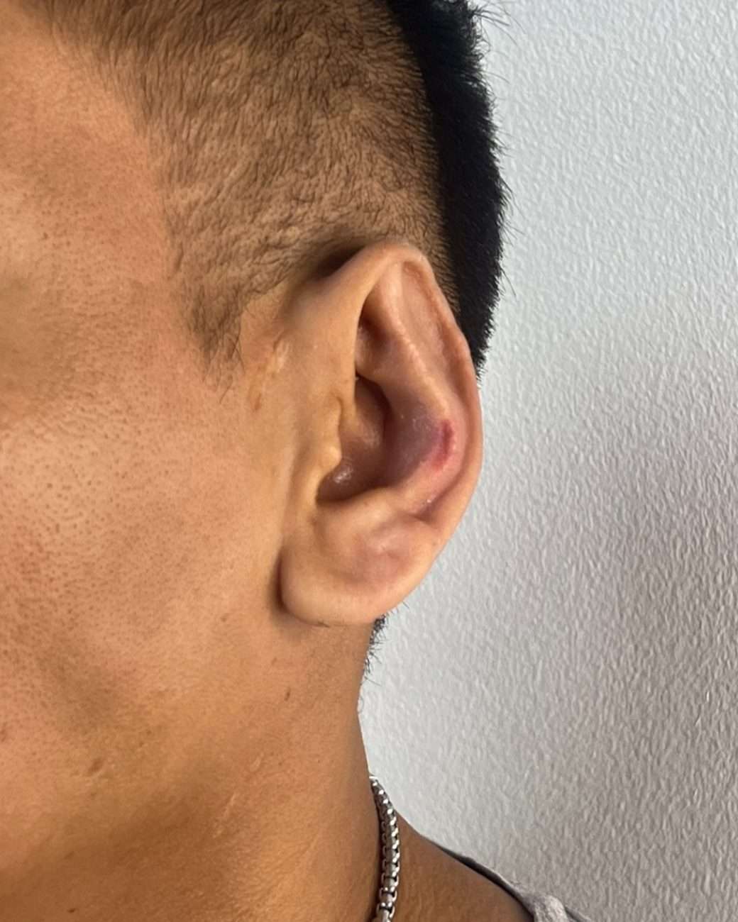 otoplastia el salvador