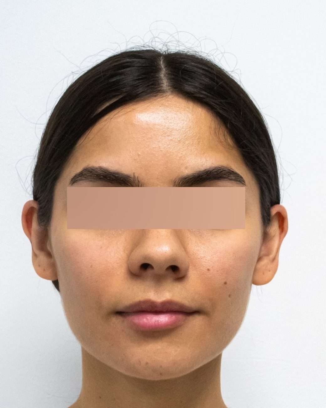 otoplastia