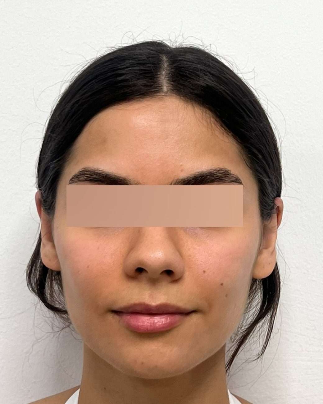 otoplastia el salvador