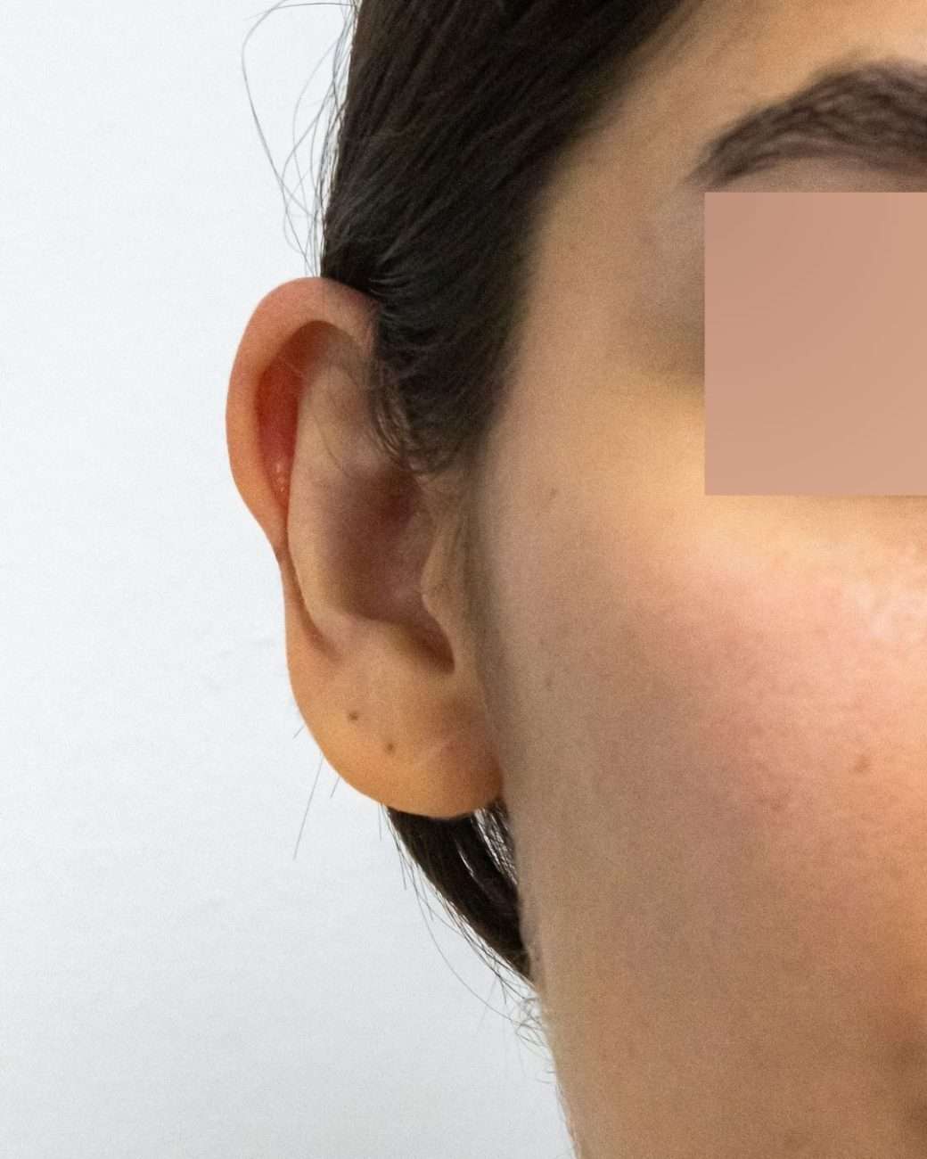 otoplastia