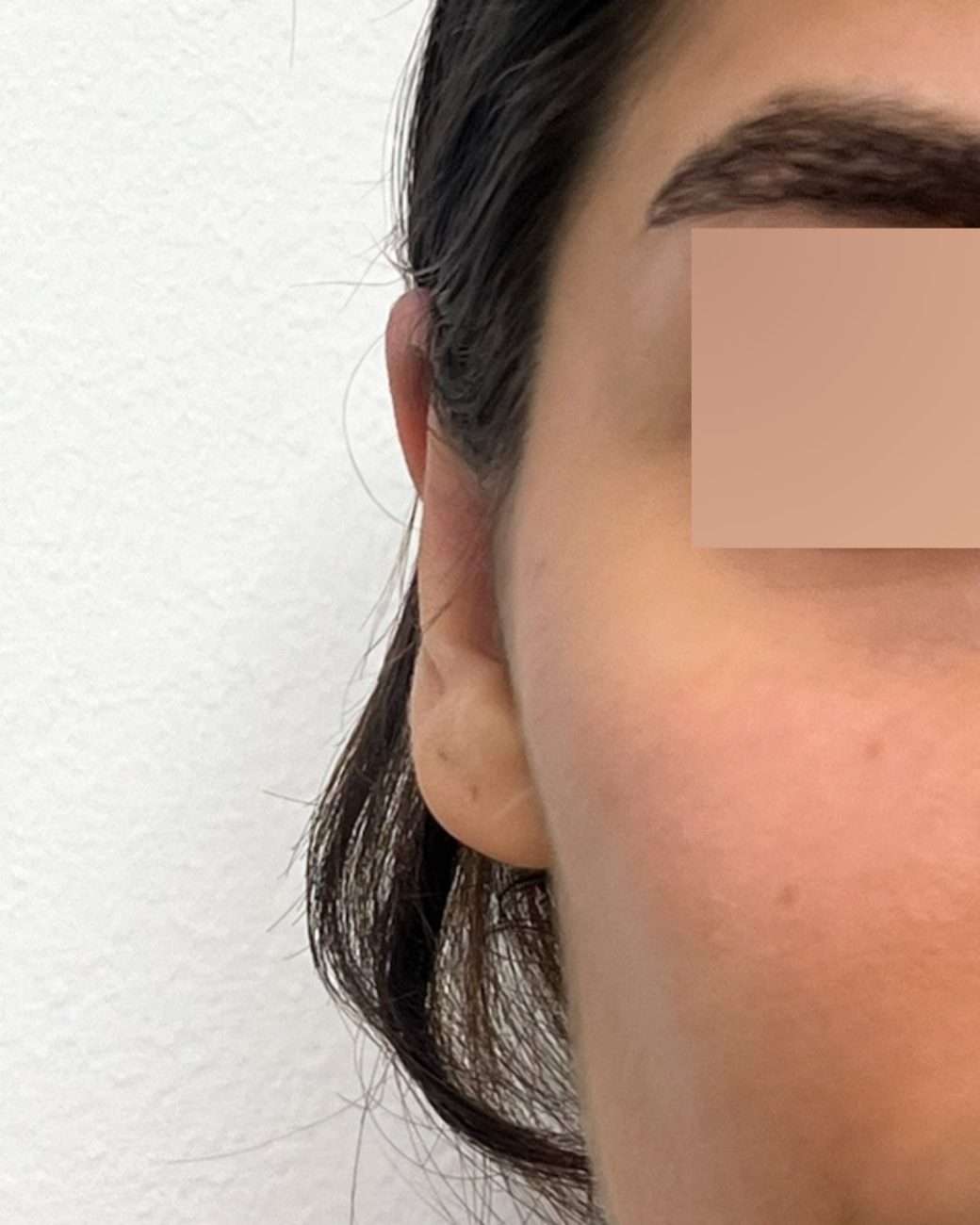 otoplastia el salvador