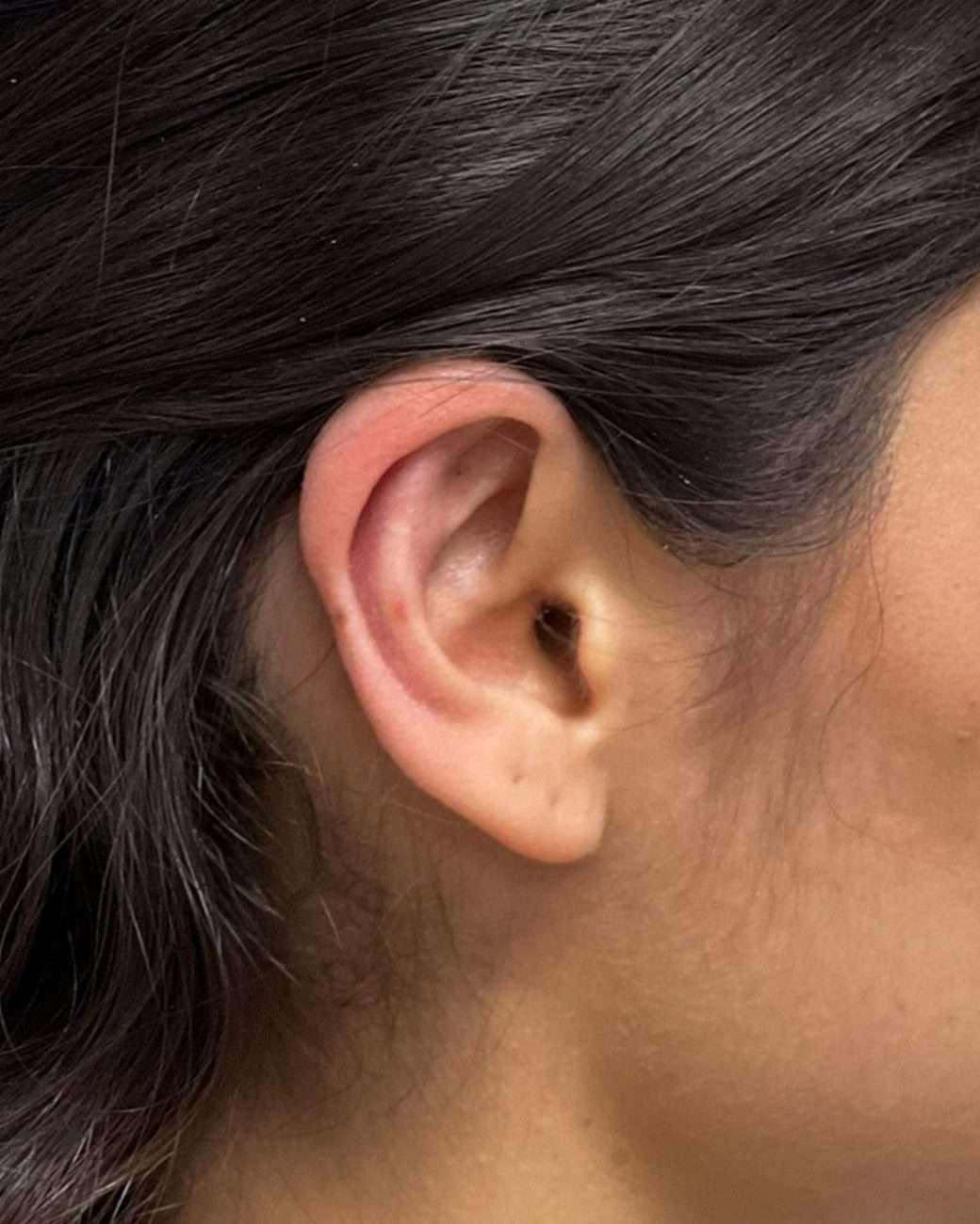 otoplastia el salvador