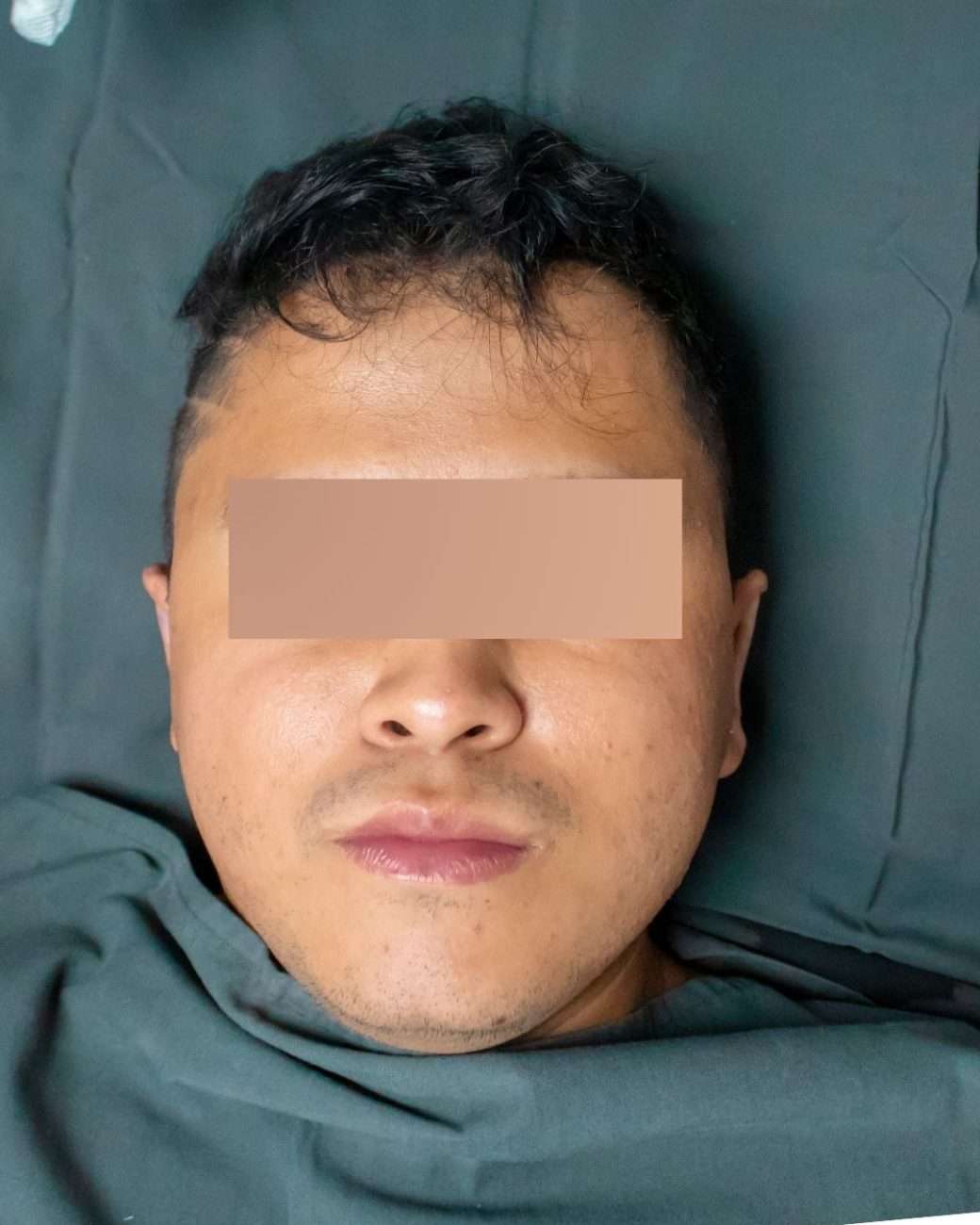 otoplastia el salvador