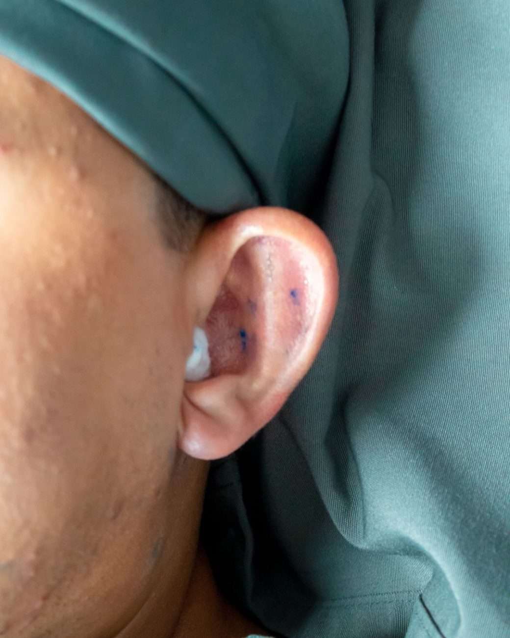 otoplastia
