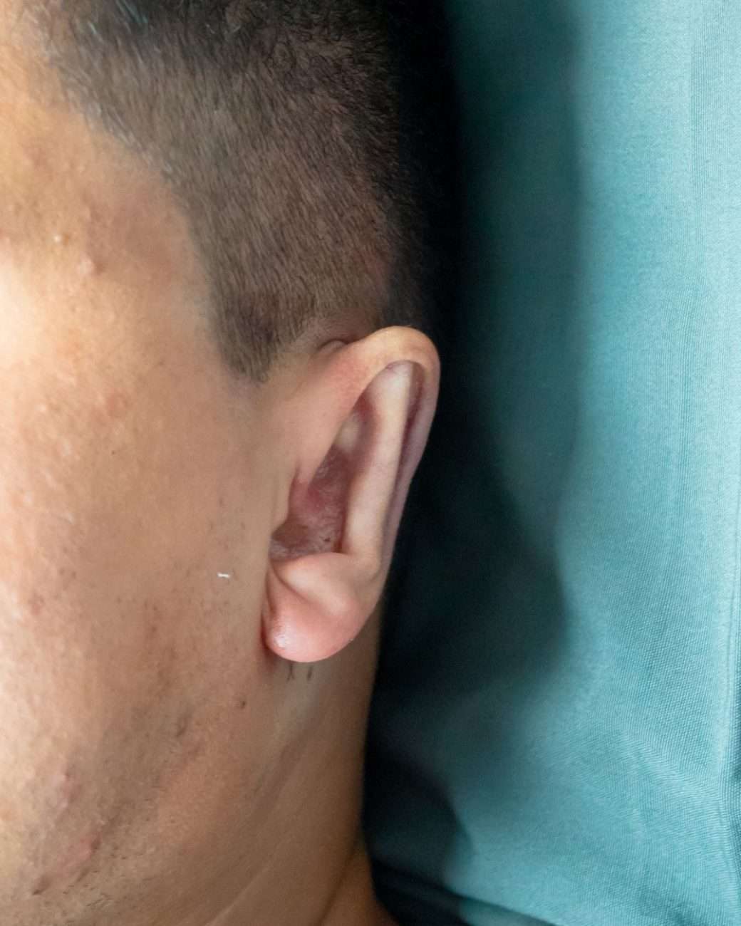 otoplastia el salvador
