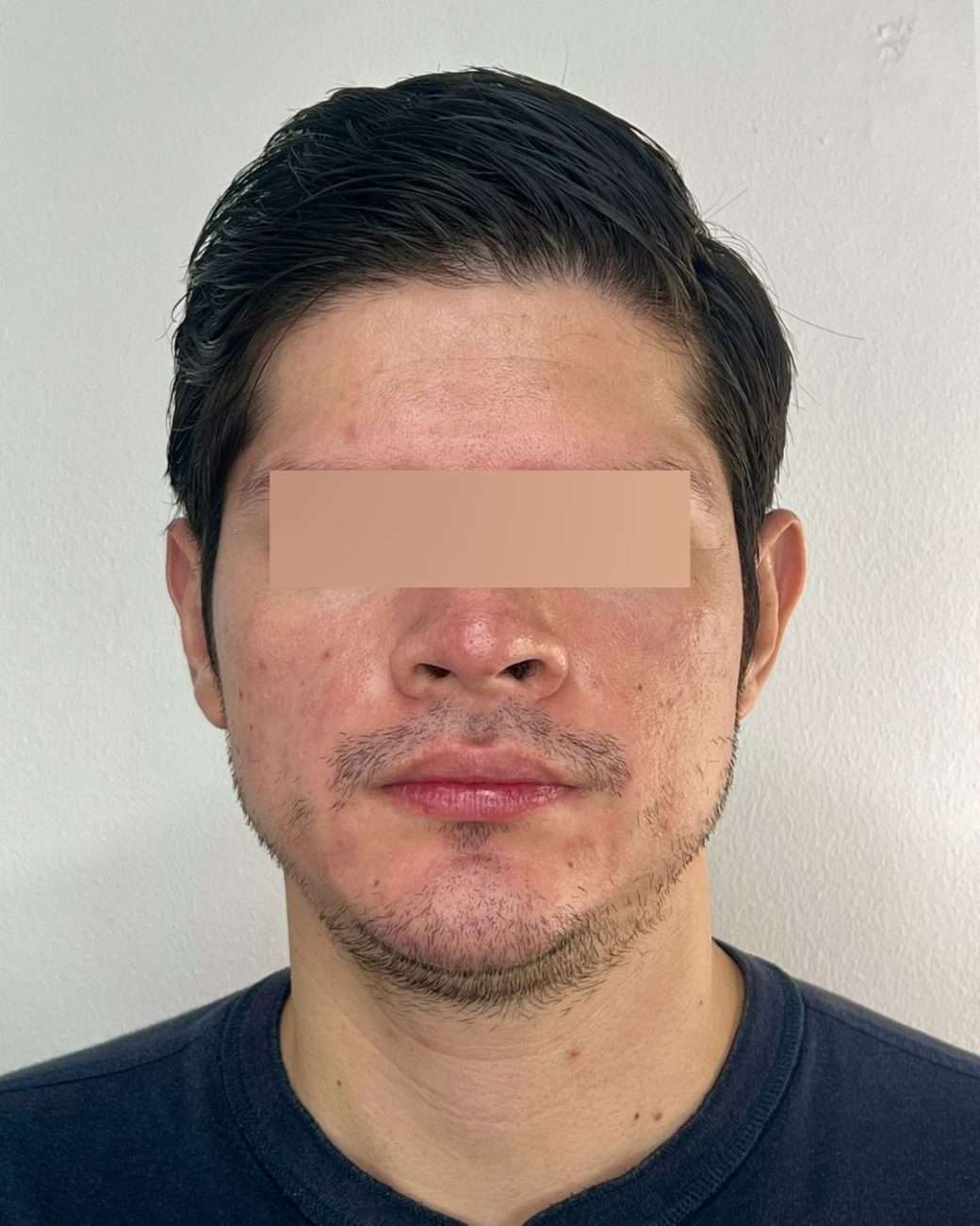 otoplastia el salvador