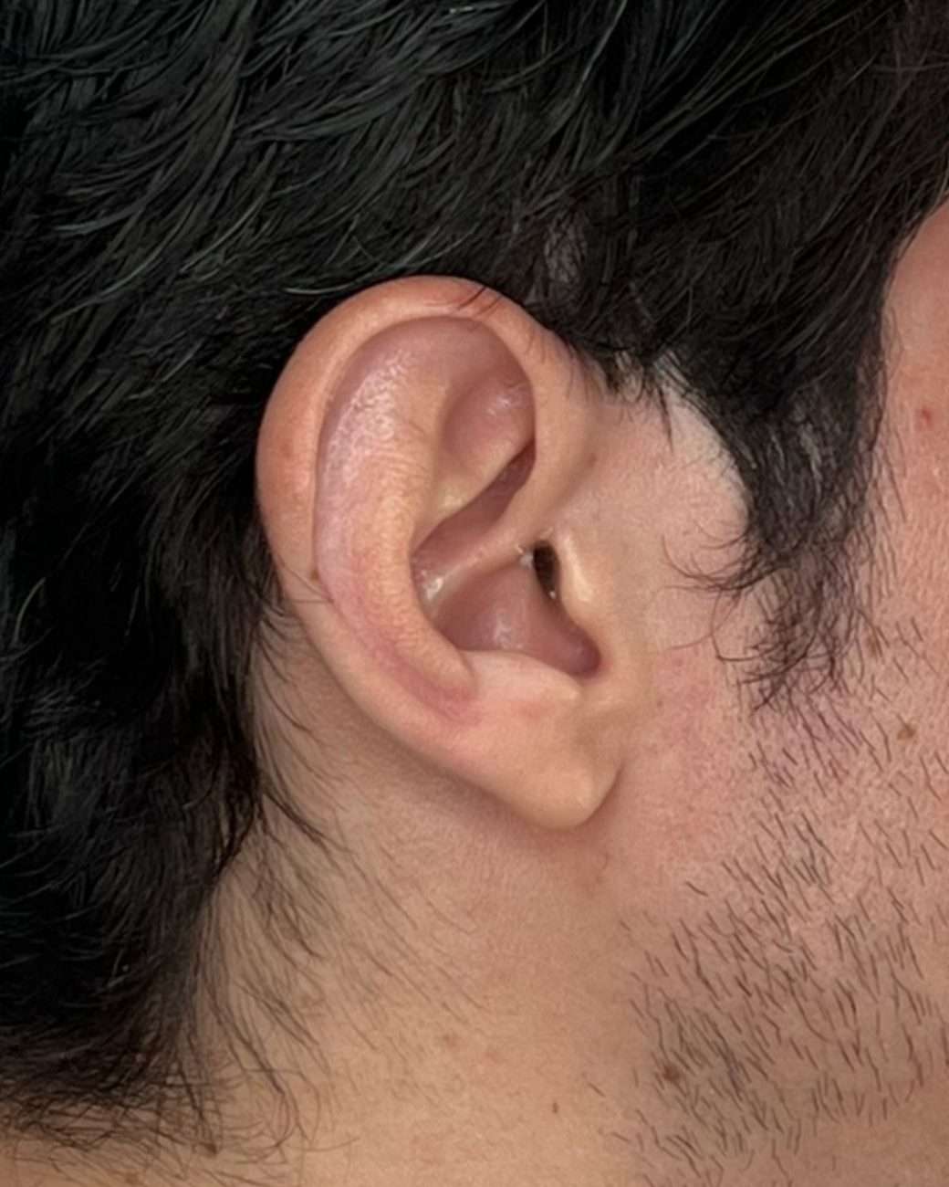 otoplastia el salvador