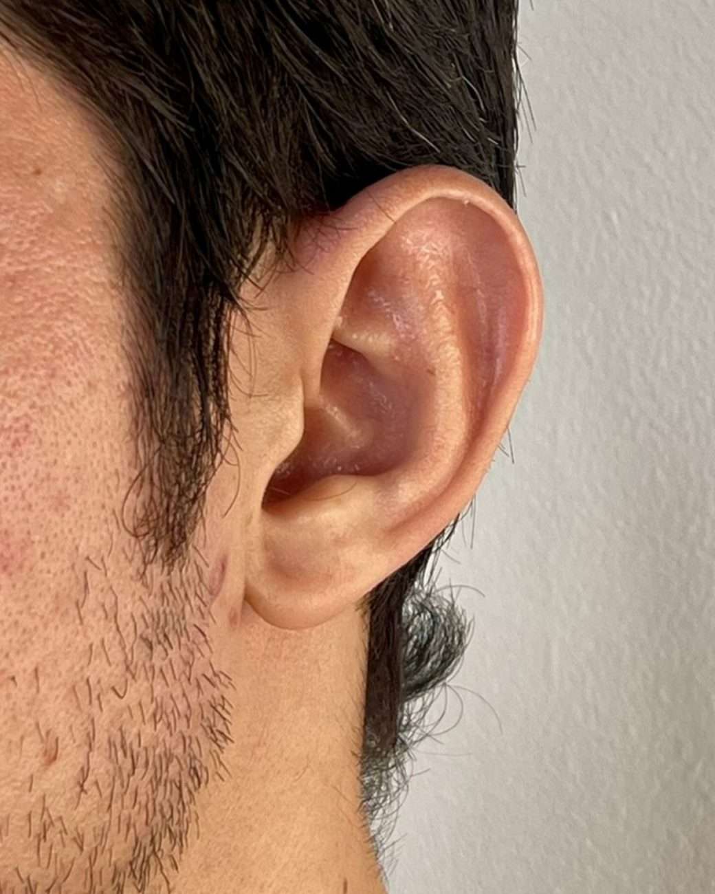 otoplastia el salvador